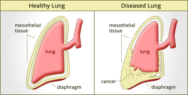 What Are The Different Types Of Mesothelioma Cancer